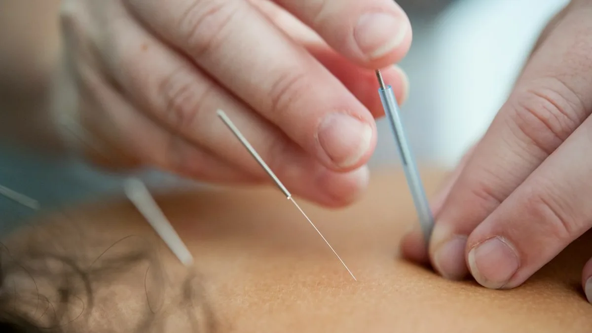 Acupuncture pour arrêt du tabac : ce qu'il faut savoir