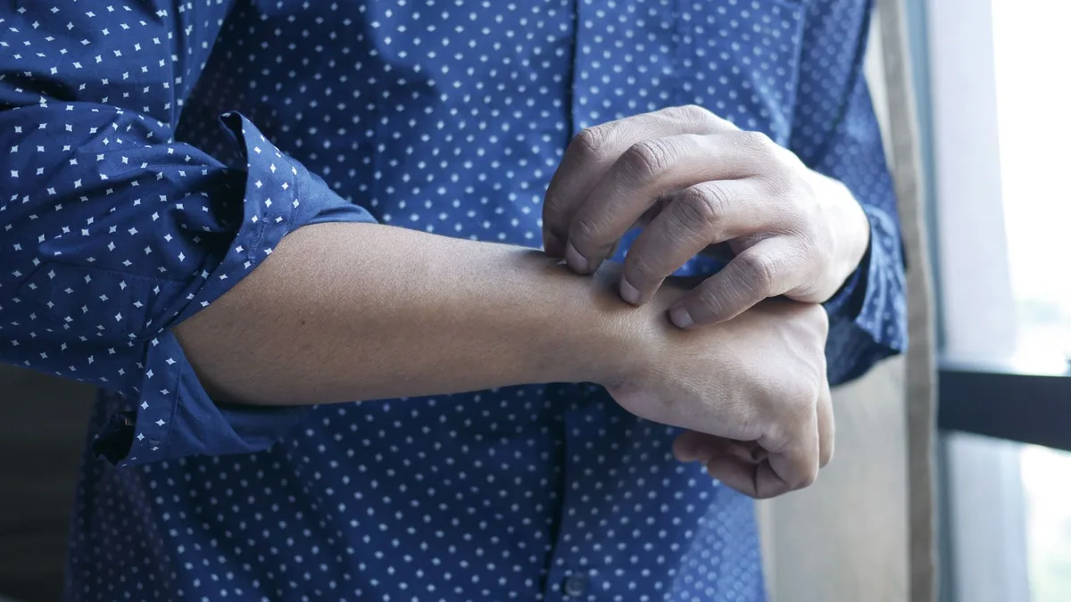 Stress et urticaire : les critères qui décident